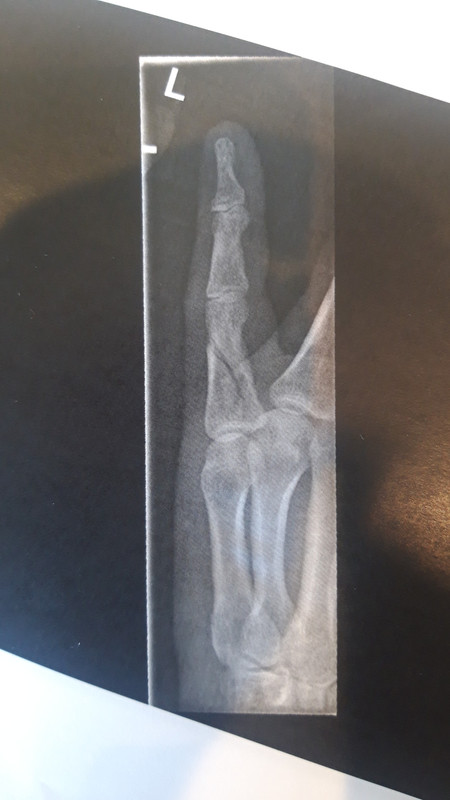 spiral fracture to proximal phalanx